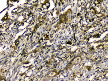 SIRT4 / Sirtuin 4 Antibody - IHC staining of FFPE human rectal cancer with SIRT4 antibody at 1ug/ml. HIER: boil tissue sections in pH6, 10mM citrate buffer, for 10-20 min and allow to cool before testing.
