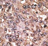 SIRT5 / Sirtuin 5 Antibody - Formalin-fixed and paraffin-embedded human cancer tissue reacted with the primary antibody, which was peroxidase-conjugated to the secondary antibody, followed by DAB staining. This data demonstrates the use of this antibody for immunohistochemistry; clinical relevance has not been evaluated. BC = breast carcinoma; HC = hepatocarcinoma.