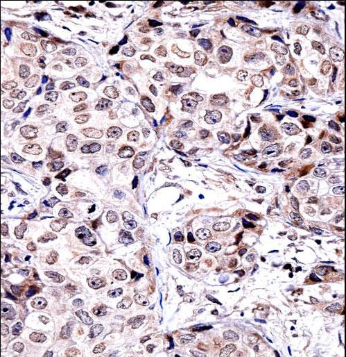 SIRT6 / Sirtuin 6 Antibody - SIRT6 Antibody immunohistochemistry of formalin-fixed and paraffin-embedded human breast carcinoma followed by peroxidase-conjugated secondary antibody and DAB staining.