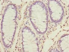 SKAP2 / SCAP2 Antibody - Immunohistochemistry of paraffin-embedded human colon cancer at dilution 1:100