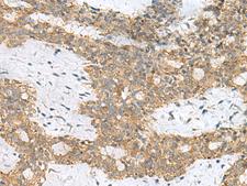SKI Antibody - Immunohistochemistry of paraffin-embedded Human breast cancer tissue  using SKI Polyclonal Antibody at dilution of 1:70(×200)