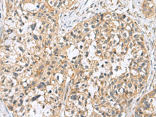 SKI Antibody - Immunohistochemistry of paraffin-embedded Human esophagus cancer tissue  using SKI Polyclonal Antibody at dilution of 1:70(×200)