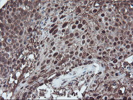 SKIL / SNO / SnoN Antibody - IHC of paraffin-embedded Carcinoma of Human lung tissue using anti-SKIL mouse monoclonal antibody.