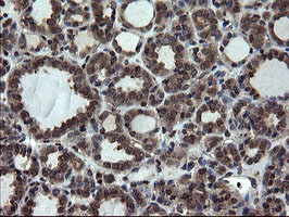 SKIL / SNO / SnoN Antibody - IHC of paraffin-embedded Carcinoma of Human thyroid tissue using anti-SKIL mouse monoclonal antibody.