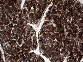 SKIL / SNO / SnoN Antibody - IHC of paraffin-embedded Carcinoma of Human liver tissue using anti-SKIL mouse monoclonal antibody.