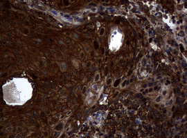 SKIL / SNO / SnoN Antibody - IHC of paraffin-embedded Carcinoma of Human lung tissue using anti-SKIL mouse monoclonal antibody.