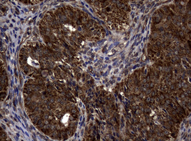 SKIL / SNO / SnoN Antibody - IHC of paraffin-embedded Adenocarcinoma of Human ovary tissue using anti-SKIL mouse monoclonal antibody.