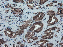 SKIL / SNO / SnoN Antibody - IHC of paraffin-embedded Carcinoma of Human prostate tissue using anti-SKIL mouse monoclonal antibody.