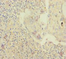 SKIV2L / SKI2 Antibody - Immunohistochemistry of paraffin-embedded human lung cancer at dilution of 1:100