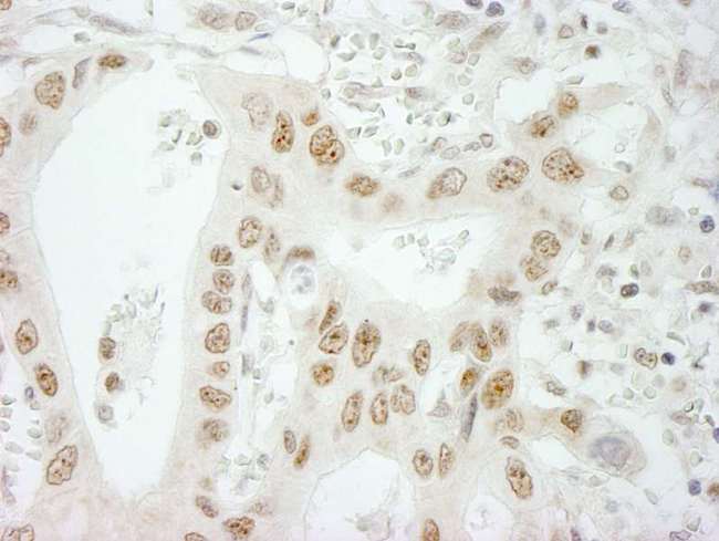 SKIV2L2 Antibody - Detection of Human SKIV2L2 by Immunohistochemistry. Sample: FFPE section of human lung adenocarcinoma. Antibody: Affinity purified rabbit anti-SKIV2L2 used at a dilution of 1:250. Epitope Retrieval Buffer-High pH (IHC-101J) was substituted for Epitope Retrieval Buffer-Reduced pH.