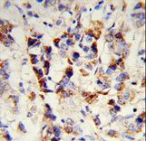 SKIV2L2 Antibody - Formalin-fixed and paraffin-embedded human breast carcinoma reacted with SKIV2L2 Antibody , which was peroxidase-conjugated to the secondary antibody, followed by DAB staining. This data demonstrates the use of this antibody for immunohistochemistry; clinical relevance has not been evaluated.