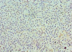 SKP1 Antibody - Immunohistochemistry of paraffin-embedded human breast cancer using antibody at 1:100 dilution.