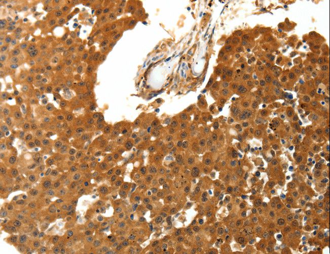 SKP1 Antibody - Immunohistochemistry of paraffin-embedded Human breast cancer using SKP1 Polyclonal Antibody at dilution of 1:30.