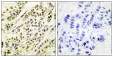 SKP1 Antibody - Peptide - + Immunohistochemistry analysis of paraffin-embedded human breast carcinoma tissue using SKP1A/p19 antibody.