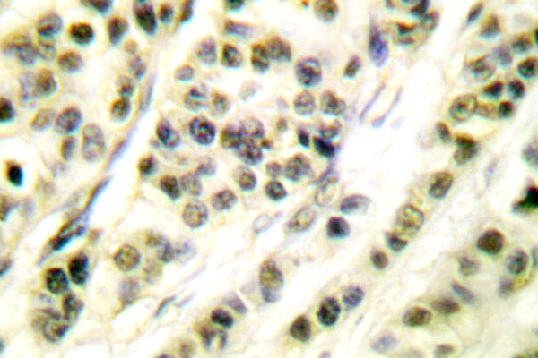 SKP1 Antibody - IHC of Skp1 p19 (P72) pAb in paraffin-embedded human breast carcinoma tissue.