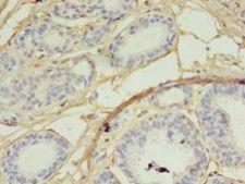 SKP2 Antibody - Immunohistochemistry of paraffin-embedded human breast cancer using antibody at 1:100 dilution.  This image was taken for the unconjugated form of this product. Other forms have not been tested.