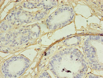 SKP2 Antibody - Immunohistochemistry of paraffin-embedded human breast cancer using SKP2 Antibody at dilution of 1:100