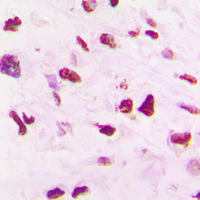 SKP2 Antibody - Immunohistochemical analysis of SKP2 staining in human lung cancer formalin fixed paraffin embedded tissue section. The section was pre-treated using heat mediated antigen retrieval with sodium citrate buffer (pH 6.0). The section was then incubated with the antibody at room temperature and detected using an HRP conjugated compact polymer system. DAB was used as the chromogen. The section was then counterstained with hematoxylin and mounted with DPX.
