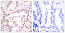 SKP2 Antibody - Peptide - + Immunohistochemical analysis of paraffin-embedded human lung carcinoma tissue using SKP2/p45 antibody.