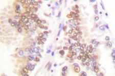 SKP2 Antibody - IHC of SKP2/p45 (P399) pAb in paraffin-embedded human lung carcinoma tissue.