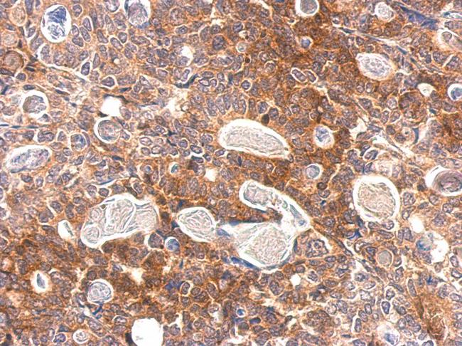 SLA Antibody - Slap antibody detects SLA protein at cytosol on gastric carcinoma by immunohistochemical analysis. Sample: Paraffin-embedded gastric carcinoma. Slap antibody dilution:1:500.