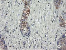 SLA2 / SLAP2 Antibody - IHC of paraffin-embedded Adenocarcinoma of Human colon tissue using anti-SLA2 mouse monoclonal antibody. (Heat-induced epitope retrieval by 10mM citric buffer, pH6.0, 100C for 10min).