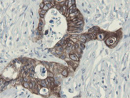 SLA2 / SLAP2 Antibody - IHC of paraffin-embedded Adenocarcinoma of Human colon tissue using anti-SLA2 mouse monoclonal antibody.