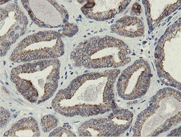 SLA2 / SLAP2 Antibody - IHC of paraffin-embedded Carcinoma of Human prostate tissue using anti-SLA2 mouse monoclonal antibody.