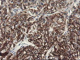 SLA2 / SLAP2 Antibody - IHC of paraffin-embedded Carcinoma of Human kidney tissue using anti-SLA2 mouse monoclonal antibody.