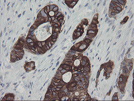 SLA2 / SLAP2 Antibody - IHC of paraffin-embedded Adenocarcinoma of Human colon tissue using anti-SLA2 mouse monoclonal antibody.