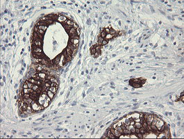 SLA2 / SLAP2 Antibody - IHC of paraffin-embedded Carcinoma of Human prostate tissue using anti-SLA2 mouse monoclonal antibody.