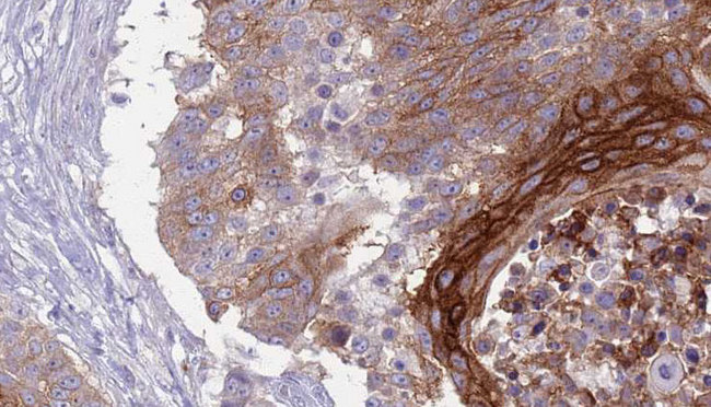 SLAMF1 / SLAM / CD150 Antibody - 1:100 staining human urothelial carcinoma tissue by IHC-P. The sample was formaldehyde fixed and a heat mediated antigen retrieval step in citrate buffer was performed. The sample was then blocked and incubated with the antibody for 1.5 hours at 22°C. An HRP conjugated goat anti-rabbit antibody was used as the secondary.