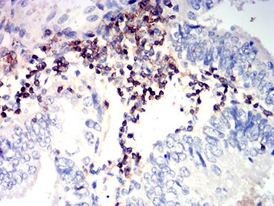 SLAMF6 / NTBA Antibody - Immunohistochemical analysis of paraffin-embedded endometrial cancer tissues using CD352 mouse mAb with DAB staining.