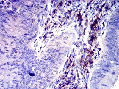 SLAMF6 / NTBA Antibody - Immunohistochemical analysis of paraffin-embedded rectum cancer tissues using CD352 mouse mAb with DAB staining.