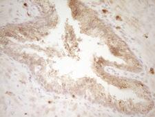 SLAMF7 / CRACC Antibody - Immunohistochemical staining of paraffin-embedded Adenocarcinoma of Human endometrium tissue using anti-SLAMF7 mouse monoclonal antibody. (Heat-induced epitope retrieval by 1 mM EDTA in 10mM Tris, pH8.5, 120C for 3min,