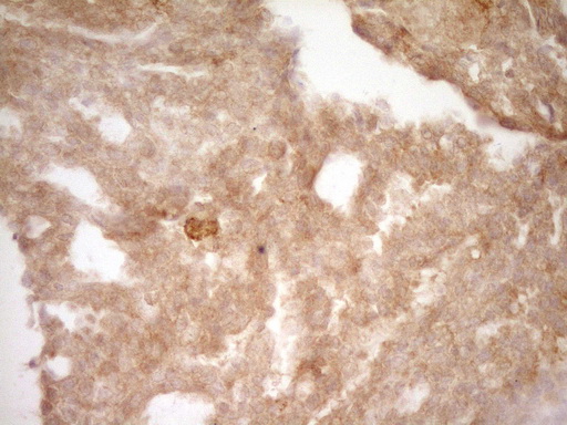 SLAMF7 / CRACC Antibody - Immunohistochemical staining of paraffin-embedded Adenocarcinoma of Human breast tissue using anti-SLAMF7 mouse monoclonal antibody. (Heat-induced epitope retrieval by 1 mM EDTA in 10mM Tris, pH8.5, 120C for 3min,