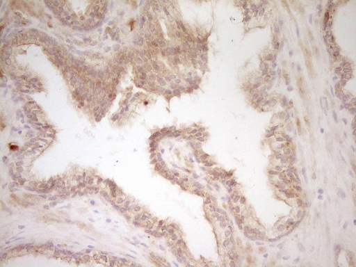 SLAMF7 / CRACC Antibody - Immunohistochemical staining of paraffin-embedded Carcinoma of Human prostate tissue using anti-SLAMF7 mouse monoclonal antibody. (Heat-induced epitope retrieval by 1 mM EDTA in 10mM Tris, pH8.5, 120C for 3min,