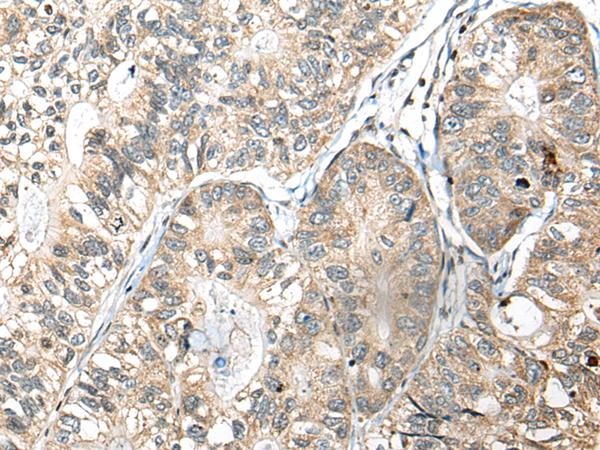 SLAMF7 / CRACC Antibody - Immunohistochemistry of paraffin-embedded Human gastric cancer tissue  using SLAMF7 Polyclonal Antibody at dilution of 1:30(×200)