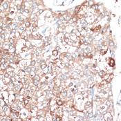SLAMF7 / CRACC Antibody - Immunohistochemistry of paraffin-embedded Human liver cancer using SLAMF7 Polyclonal Antibody at dilution of 1:100 (40x lens).