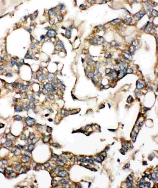 SLC10A1 / NTCP Antibody - Anti-SLC10A1 antibody, IHC(P): Human Liver Cancer Tissue