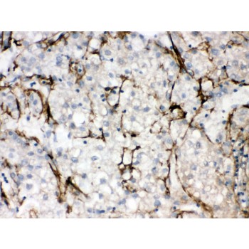 SLC10A1 / NTCP Antibody - SLC10A1 antibody IHC-paraffin. IHC(P): Human Liver Cancer Tissue.