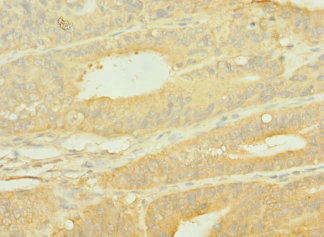 SLC10A2 / ASBT Antibody - Immunohistochemistry of paraffin-embedded human endometrial cancer using SLC10A2 Antibody at dilution of 1:100