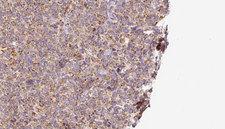 SLC10A2 / ASBT Antibody - 1:100 staining human lymph carcinoma tissue by IHC-P. The sample was formaldehyde fixed and a heat mediated antigen retrieval step in citrate buffer was performed. The sample was then blocked and incubated with the antibody for 1.5 hours at 22°C. An HRP conjugated goat anti-rabbit antibody was used as the secondary.