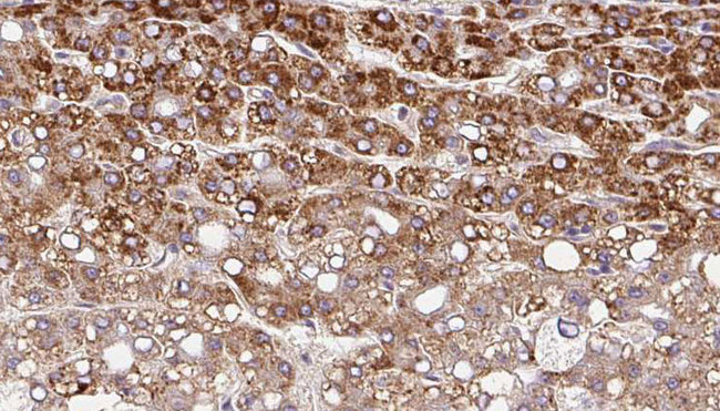 SLC10A4 Antibody - 1:100 staining human liver carcinoma tissues by IHC-P. The sample was formaldehyde fixed and a heat mediated antigen retrieval step in citrate buffer was performed. The sample was then blocked and incubated with the antibody for 1.5 hours at 22°C. An HRP conjugated goat anti-rabbit antibody was used as the secondary.