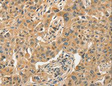 SLC11A2 / DMT1 Antibody - Immunohistochemistry of paraffin-embedded Human esophagus cancer using SLC11A2 Polyclonal Antibody at dilution of 1:50.