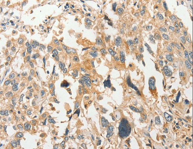 SLC11A2 / DMT1 Antibody - Immunohistochemistry of paraffin-embedded Human esophagus cancer using SLC11A2 Polyclonal Antibody at dilution of 1:50.