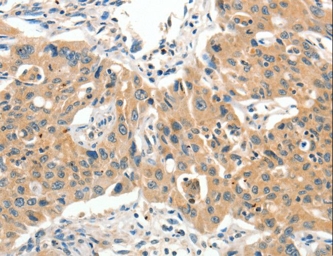 SLC11A2 / DMT1 Antibody - Immunohistochemistry of paraffin-embedded Human lung cancer using SLC11A2 Polyclonal Antibody at dilution of 1:65.