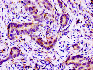 SLC11A2 / DMT1 Antibody - Immunohistochemistry image of paraffin-embedded human pancreatic cancer at a dilution of 1:100