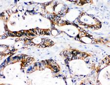 SLC12A2 / NKCC1 Antibody - SLC12A2 / NKCC1 antibody. IHC(P): Human Intestinal Cancer Tissue.
