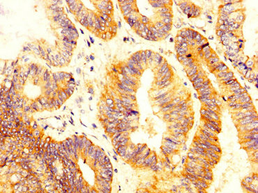 SLC12A2 / NKCC1 Antibody - Immunohistochemistry image at a dilution of 1:300 and staining in paraffin-embedded human colon cancer performed on a Leica BondTM system. After dewaxing and hydration, antigen retrieval was mediated by high pressure in a citrate buffer (pH 6.0) . Section was blocked with 10% normal goat serum 30min at RT. Then primary antibody (1% BSA) was incubated at 4 °C overnight. The primary is detected by a biotinylated secondary antibody and visualized using an HRP conjugated SP system.